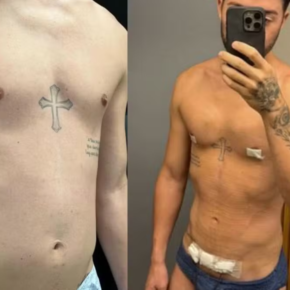 Rico Melquiades faz foto do antes e depois 8 dias após lipoaspiração