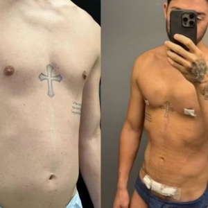 Rico Melquiades mostra antes e depois de lipoaspiração após oito dias de procedimento