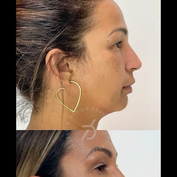 Valesca Popozuda antes e depois! Funkeira fez harmonização facial e preenchimento labial