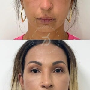 Valesca Popozuda antes e depois! Funkeira surgiu com novo rosto após três anos de procedimentos estéticos
