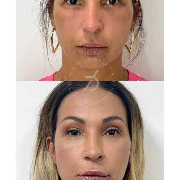 Valesca Popozuda antes e depois! Funkeira surgiu com novo rosto após três anos de procedimentos estéticos
