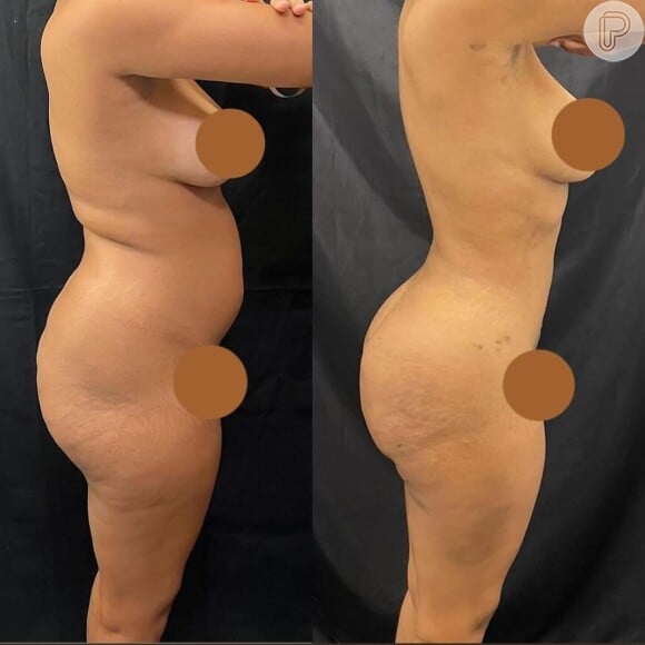 Thalyta, do 'BBB 24', compartilhou nas redes o resultado de sua lipoaspiração