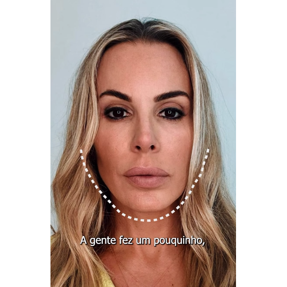 Joana Prado impressionou seus seguidores com o resultado sutil de sua harmonização facial