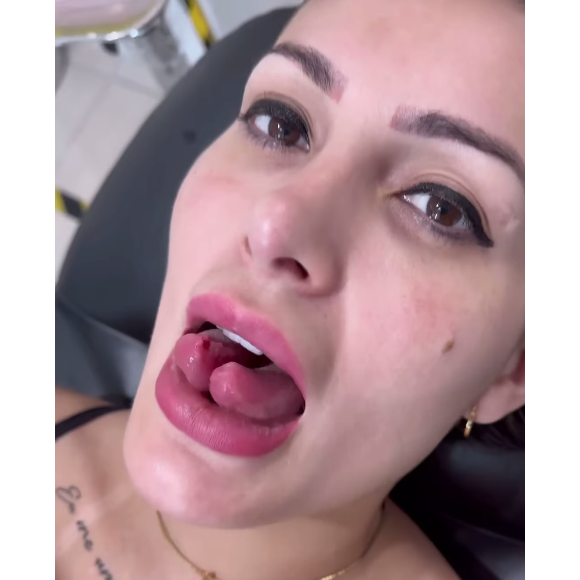 Na última segunda-feira (05), Andressa Urach mostrou a reutirada dos pontos na língua