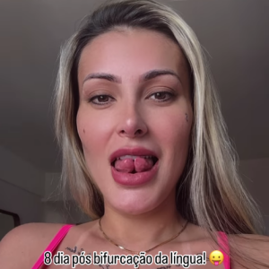 Andressa Urach disse que o pior da recuperação já passou e aproveitou para ressaltar ter amado o resultado