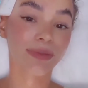 Procedimento feito por Bruna Marquezine trata tanto a flacidez facial quanto a flacidez muscular