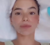 Bruna Marquezine já mostrou em suas redes sociais uma aplicação de Ultrassom Microfocado, brincando que estava com a "pele esticada e zero preenchida"