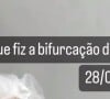 Andressa Urach fez um esclarecimento relacionado à polêmica cirurgia de bifurcação da língua