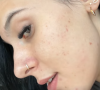 O antes e depois de Ana Castela: cantora revelou que ainda tem manchas da acne, mas já está as tratando