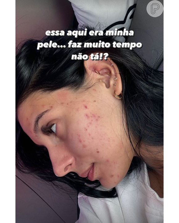 Ana Castela destacou, em uma sequência de imagens, sua pele recheada de acne nos últimos tempos