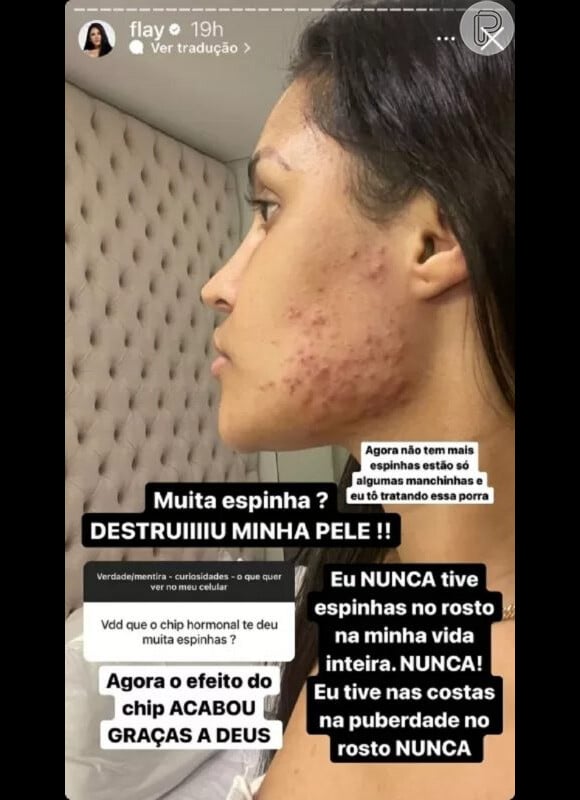 Flayslane mostrou foto das espinhas após a implantação do chip da beleza: 'Destruiu a minha pele'