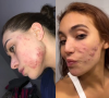 Vanessa Lopes, Ana Castela e mais famosas que falam abertamente sobre autoestima e luta contra a acne