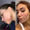 Vanessa Lopes, Ana Castela, Virginia e mais famosas que lutam contra a acne e falam abertamente sobre autoestima