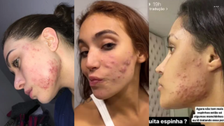 Vanessa Lopes, Ana Castela, Virginia e mais famosas que lutam contra a acne e falam abertamente sobre autoestima