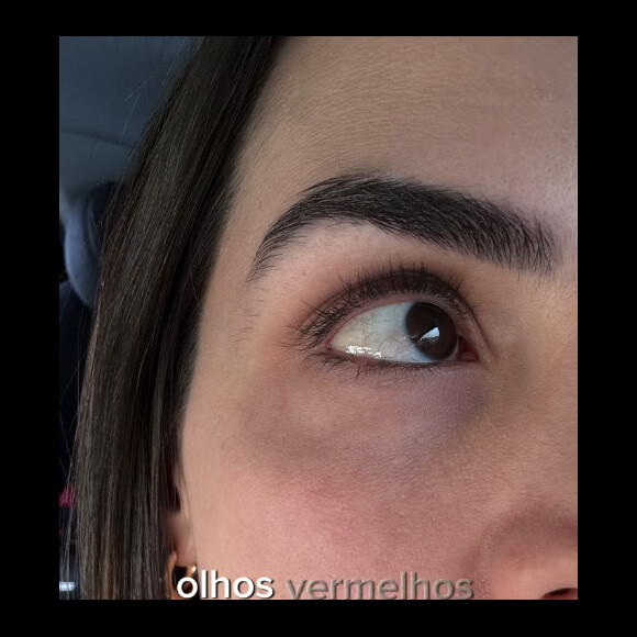Pérola Faria revela que olhos vermelhos é um dos sintomas do tratamento da doença