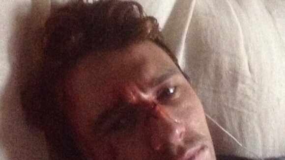 James Franco publica foto com o rosto machucado: 'Cena de Luta'