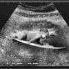 O pai postou uma montagem de um ultrassom em que um bebê aparece surfando. "Puxou ao pai", brincou ele, que adora surfar.