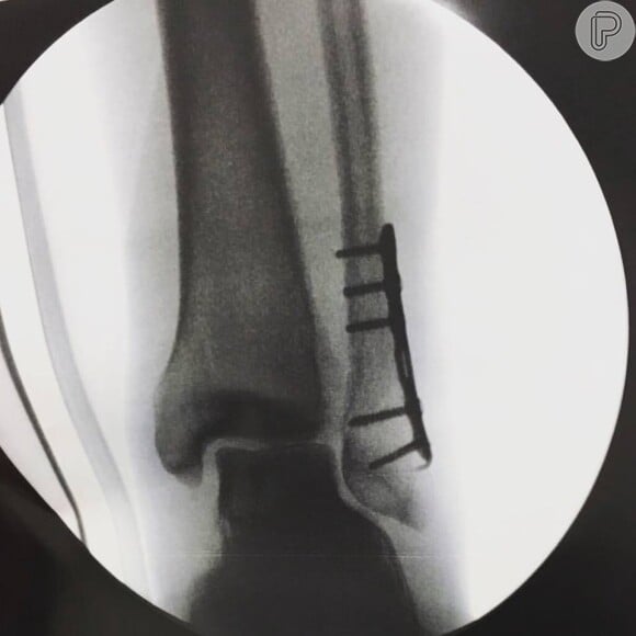 Fabio Assunção sofreu um acidente no pé esquerdo e precisou colocar pinos
