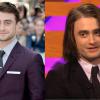 Daniel Radcliffe, o eterno Harry Potter, mudou radicalmente colocando aplique para o seu papel no filme 'Frankenstein'