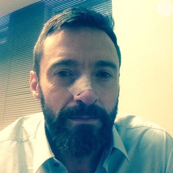 Mais uma vez, Hugh Jackman é diagnosticado com câncer no nariz 