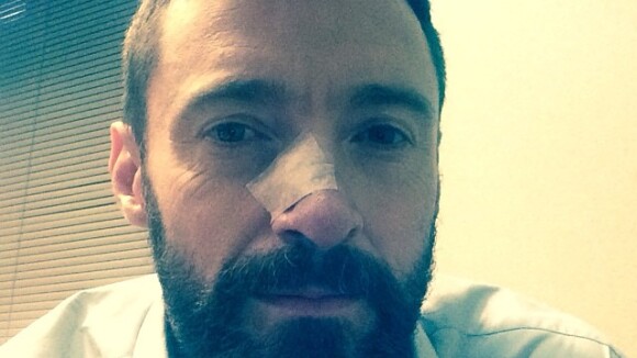 Hugh Jackman é diagnosticado com câncer de pele no nariz novamente