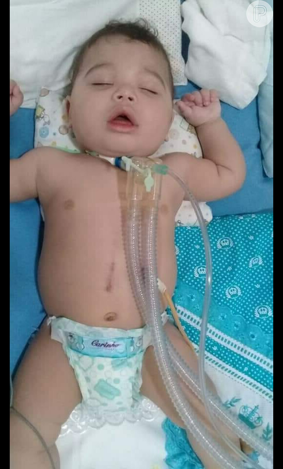 O pequeno Guilherme Barbosa de Jesus tem síndrome de Ondine, uma doença genética rara que afeta o sistema respiratório