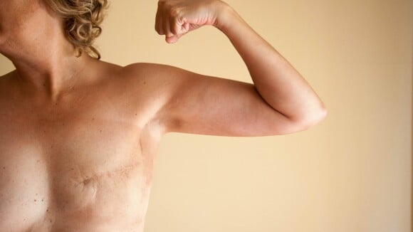 Reconstrução da mama ajuda mulheres na luta contra câncer: 'Recupera autoestima'
