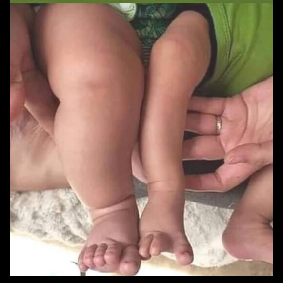 Biah Rodrigues mostrou a comparação de perninhas de dois bebês saudáveis, da mesma idade, com pesos diferentes