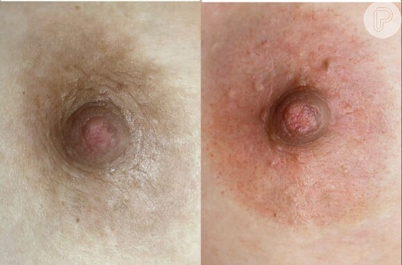 Micropigmentação vem sendo utilizada em tratamentos de reconstrução de mamas