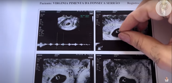 Virgínia Fonseca e obstetra fizeram as contas e deduziram, de acordo com a crença popular, sem base científica, que novo bebê será um menino