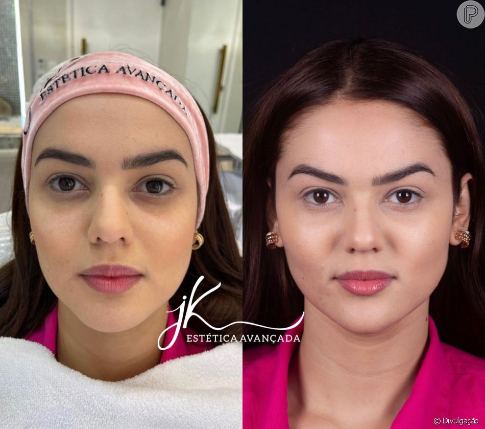 Harmonização facial de Eslovênia foi realizada nesta quarta-feira (20)