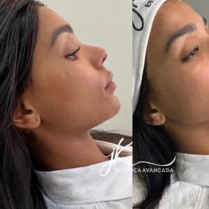 Brunna Gonçalves retocou a harmonização facial