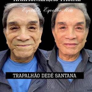 Harmonização facial de Dedé Santana viralizou no Instagram