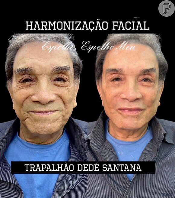 Harmonização facial de Dedé Santana viralizou no Instagram