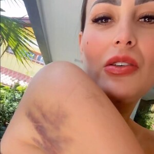 Andressa Urach mostrou o corpo cheio de hematomas