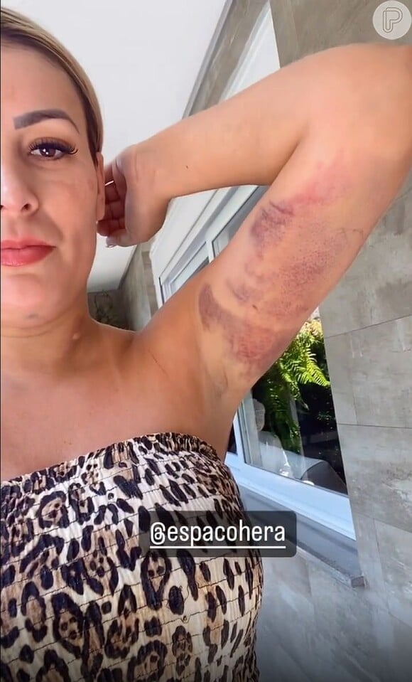 Andressa Urach contou que está cuidando do corpo no pós operatório