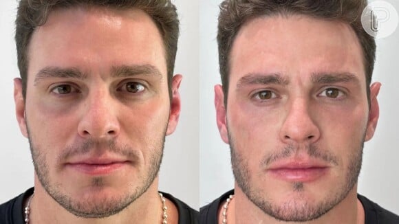 Este é o antes e o depois de Gustavo Cowboy fazer harmonização facial.
