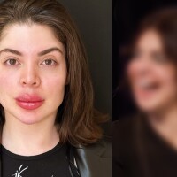 'Tirei três litros de ácido hialurônico do meu rosto', revela Gkay sobre reversão de harmonização facial e mais tratamentos estéticos. Veja o antes e o depois!