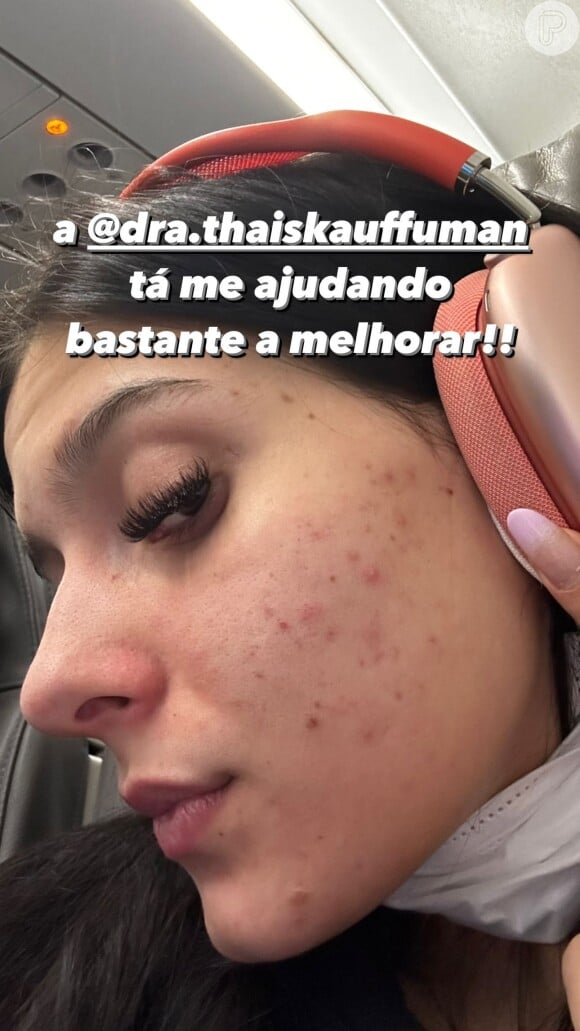 Ana Castela confessou sofrer com problema de acne