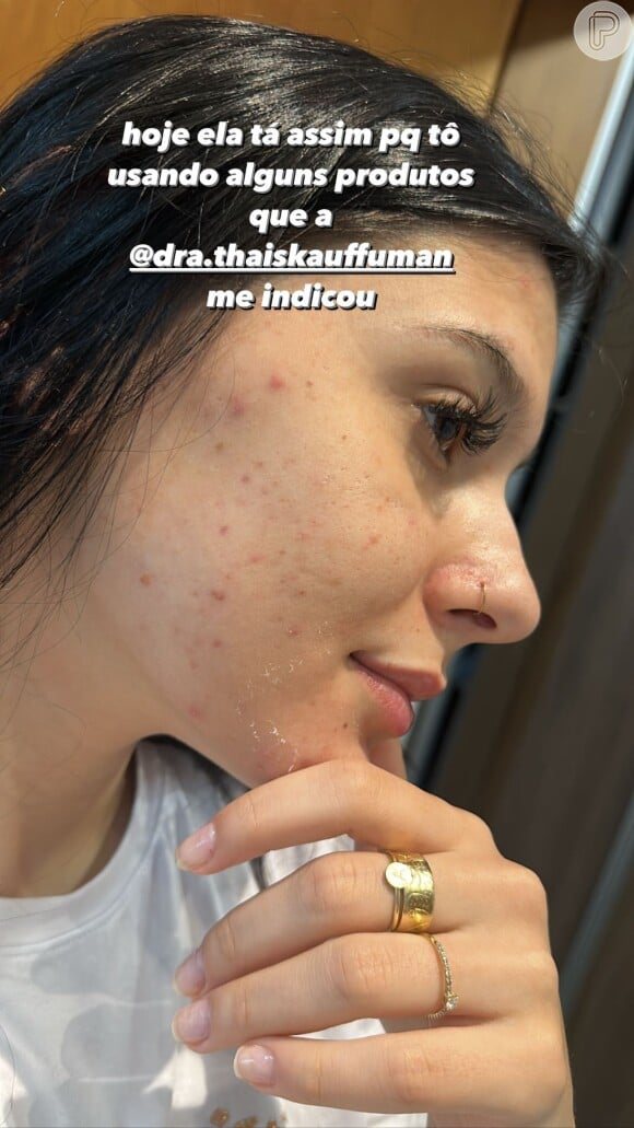 Apesar de estar fazendo tratamento, Ana Castela ainda tem bastante acne no rosto