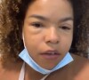 Jeniffer Nascimento foi parar no hospital após comer lagosta