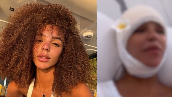 Antes e depois de Brunna Gonçalves: esposa de Ludmilla faz cirurgia para redução da testa e resultado surpreende. Veja foto!