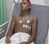 MC Brinquedo compartilha fotos dele no hospital após grave acidente