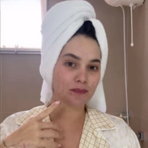 Virgínia Fonseca revela escurecimento de manchas de acne após parto de José Leonardo e médica revela como diminuí-las