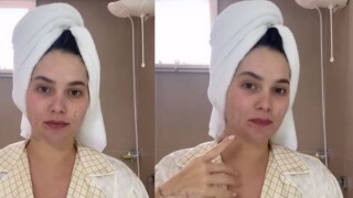 Como acabar com manchas de acne no rosto? Problema atinge Virgínia Fonseca após parto de José Leonardo e médica dá dicas infalíveis