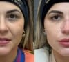 No rosto, Deolane Bezerra já fez harmonização facial, preenchimento labial, fios de PDO e aplicou botox, além de uma rinomodelação