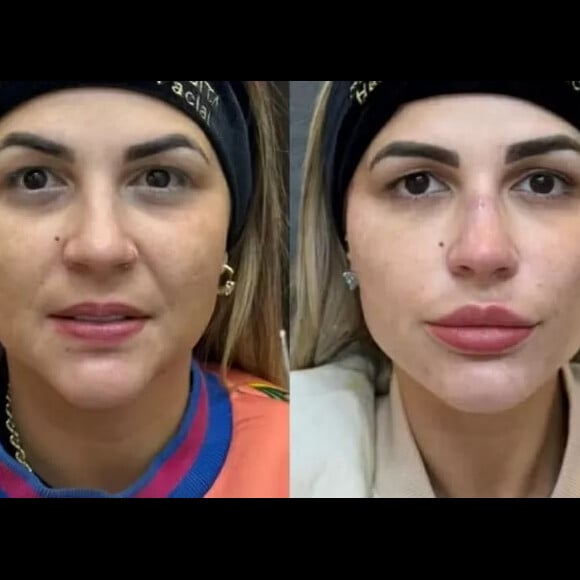 No rosto, Deolane Bezerra já fez harmonização facial, preenchimento labial, fios de PDO e aplicou botox, além de uma rinomodelação