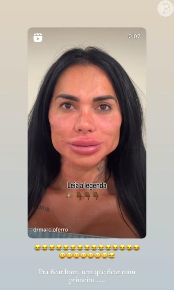 Kamila Simioni, após harmonização facial, compartilhou um vídeo em seu Instagram mostrando o resultado.