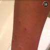 Anitta aparece com o corpo cheio de picadas de mosquito: 'No peito, na cara...', nesta sexta-feira, 31 de julho de 2015