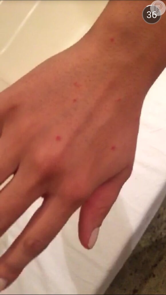 Anitta usou o Snapchat para mostrar aos seus seguidores as picadas de mosquito espalhadas pelo corpo, nesta sexta-feira, 31 de julho de 2015